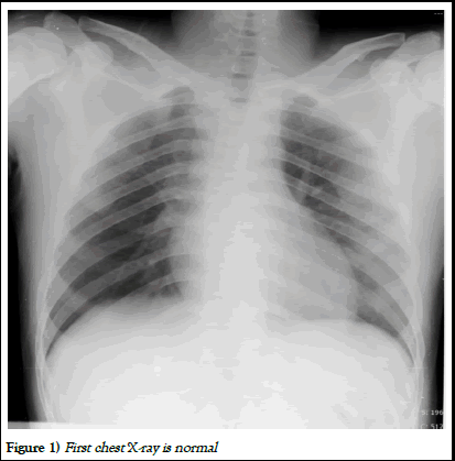 pulmtcr-x ray pulmtcr-x ray